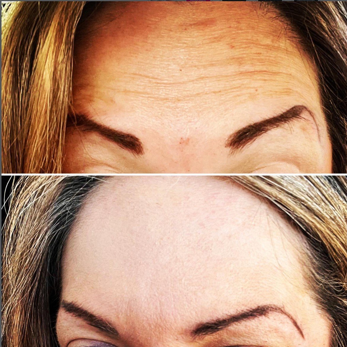 Forehead Smoothing with Botox